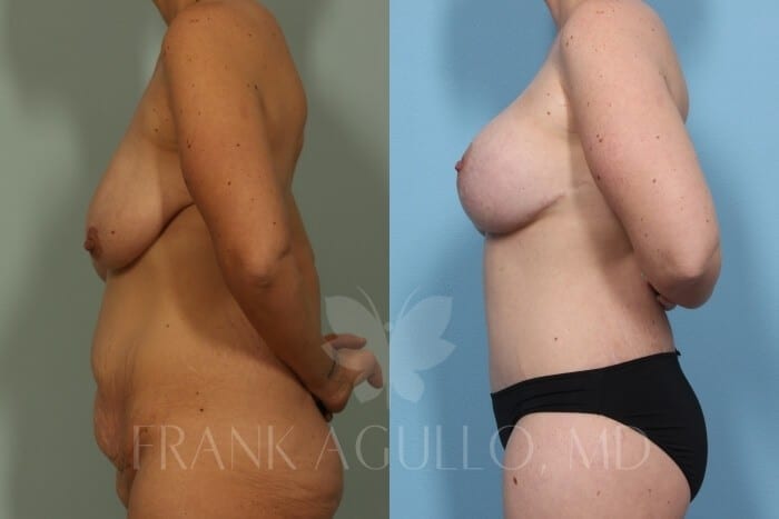 Mommy Makeover Before and After 6