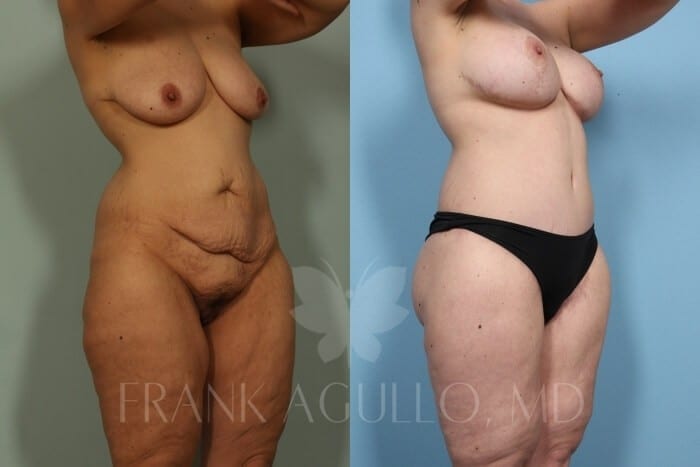 Mommy Makeover Before and After 3