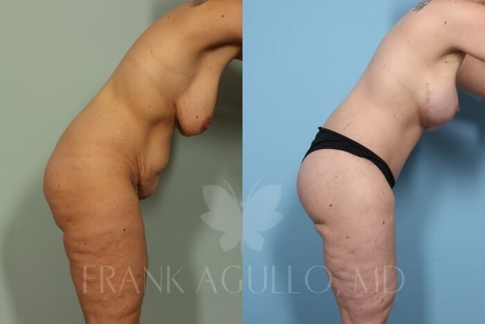 Mommy Makeover Before and After 4