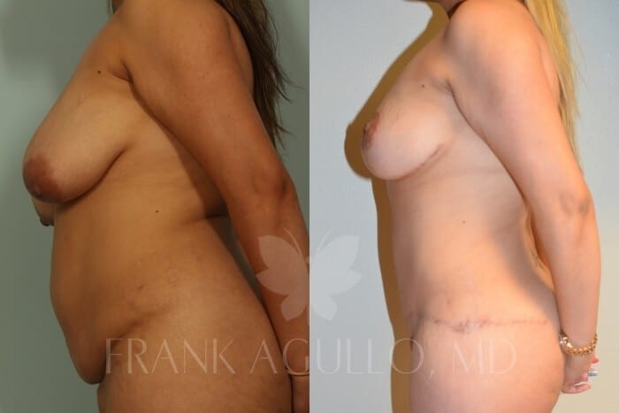 Mommy Makeover Before and After 2
