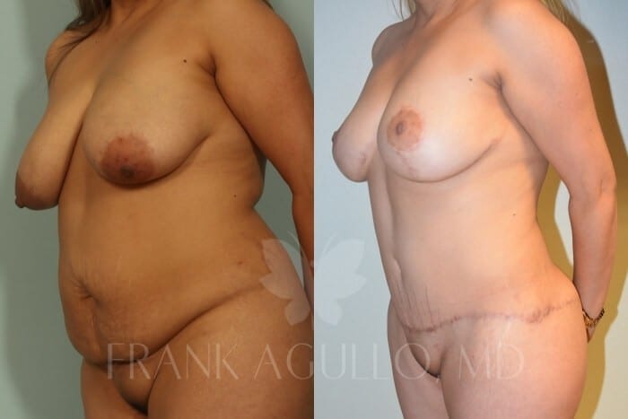 Mommy Makeover Before and After 3