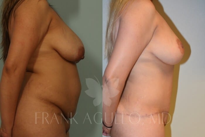 Mommy Makeover Before and After 4