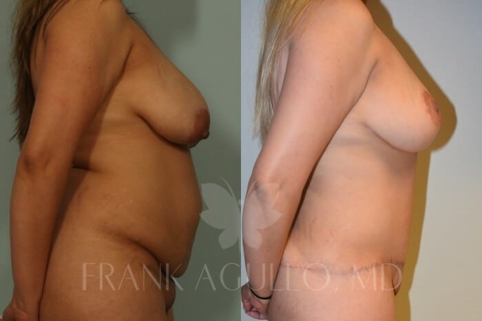 Mommy Makeover Before and After 5