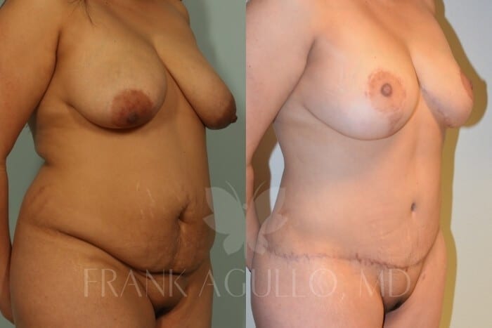 Mommy Makeover Before and After 6