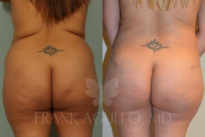 Mommy Makeover Before and After 7