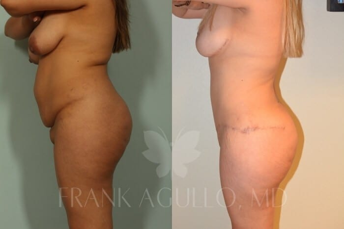 Mommy Makeover Before and After 8