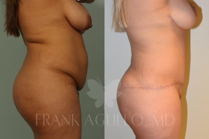 Mommy Makeover Before and After 9