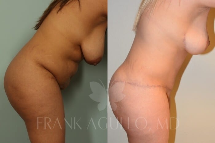 Mommy Makeover Before and After 10