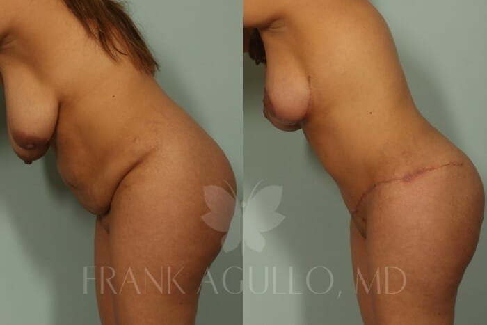 Mommy Makeover Before and After 11