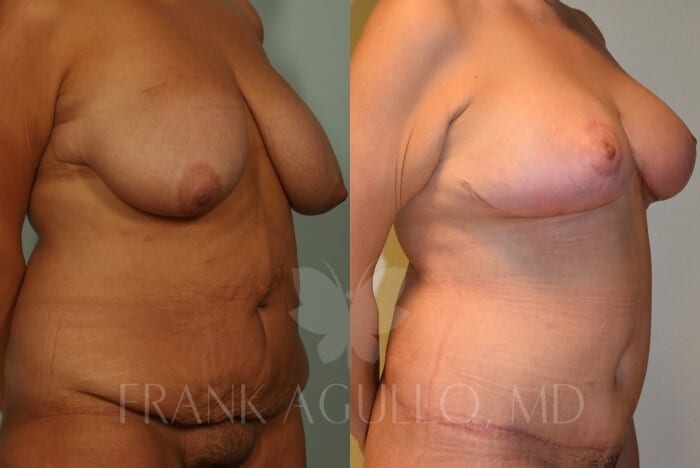 Mommy Makeover Before and After 2