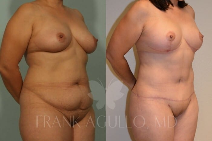 Mommy Makeover Before and After 2