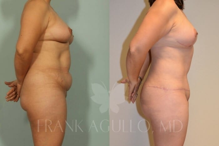 Mommy Makeover Before and After 3