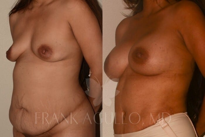 Mommy Makeover Before and After 2