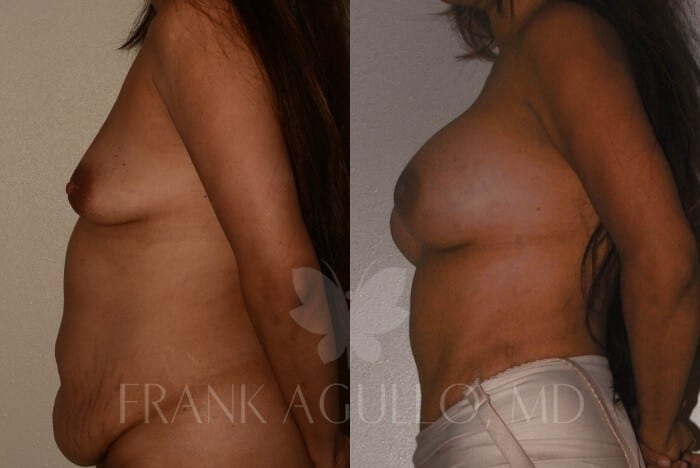 Mommy Makeover Before and After 3