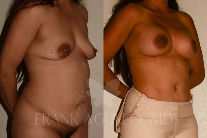 Mommy Makeover Before and After 4