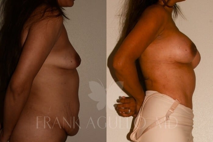Mommy Makeover Before and After 5