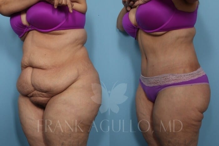 Mommy Makeover Before and After 3