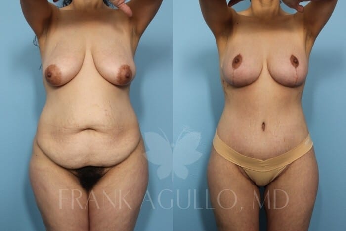 Mommy Makeover Before and After 2