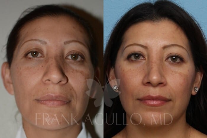 Rhinoplasty Before and After 11