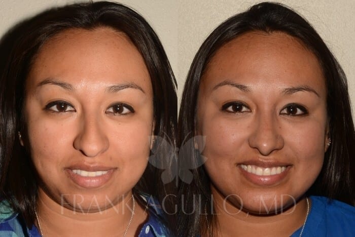 Face Before and After 6