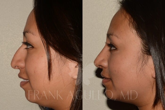 Rhinoplasty Before and After 2