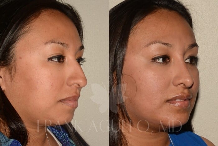 Rhinoplasty Before and After 3