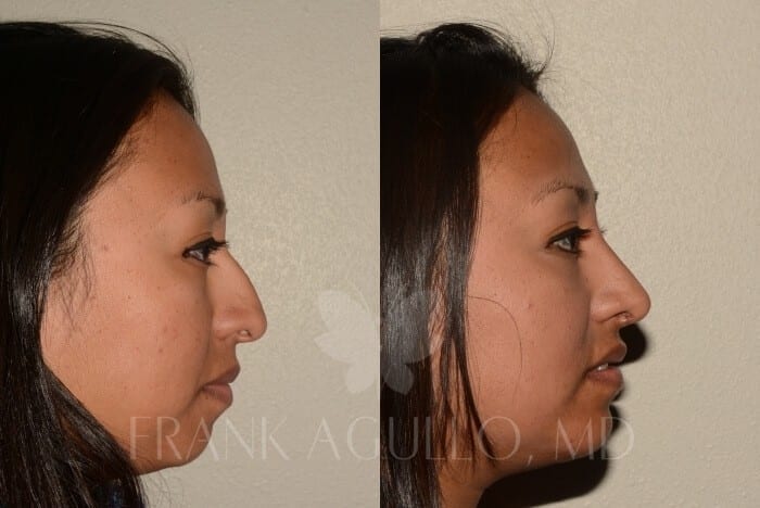 Rhinoplasty Before and After 5