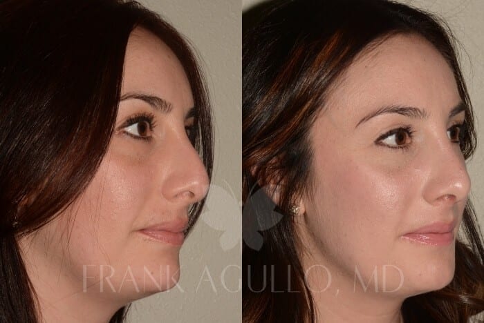 Rhinoplasty Before and After 2