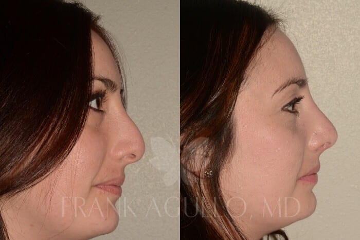 Rhinoplasty Before and After 3