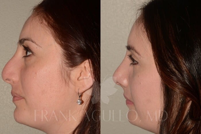 Rhinoplasty Before and After 4