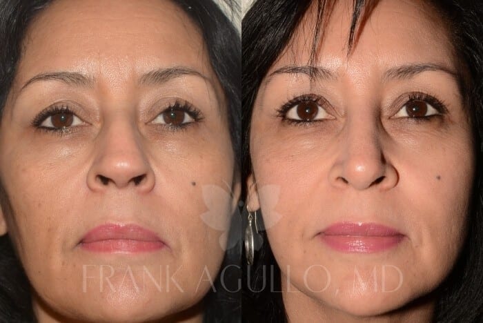 Rhinoplasty Before and After 8