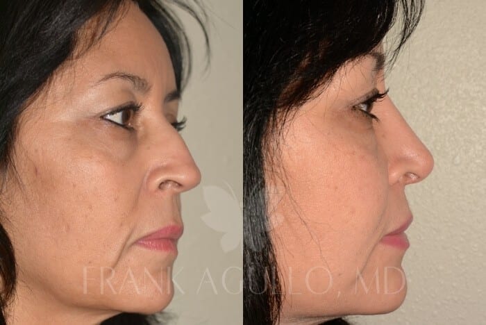 Rhinoplasty Before and After 2