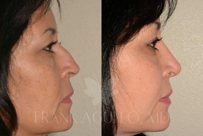 Rhinoplasty Before and After 3