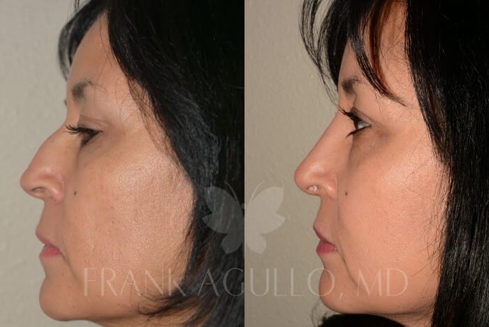 Rhinoplasty Before and After 4
