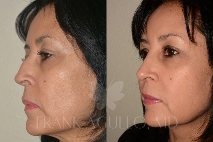 Rhinoplasty Before and After 5