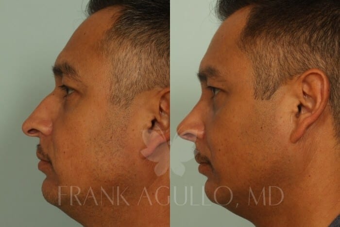 Male Rhinoplasty Nose Surgery Before and After