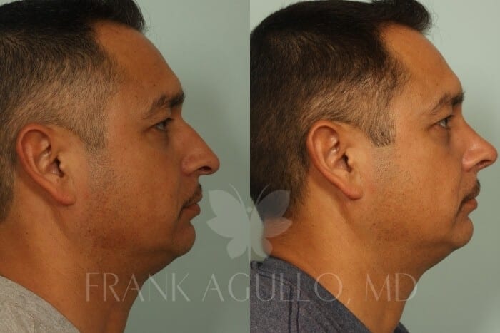 Rhinoplasty Before and After 3