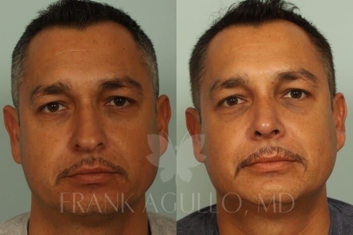 Rhinoplasty Before and After 4