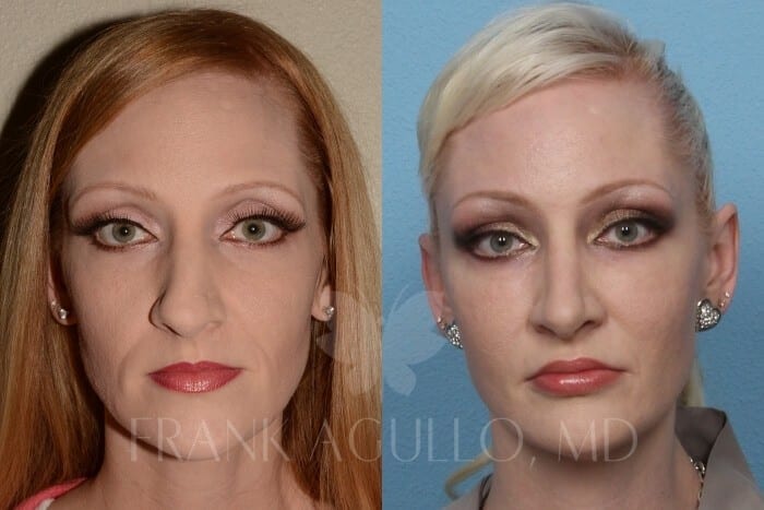Rhinoplasty Before and After 5