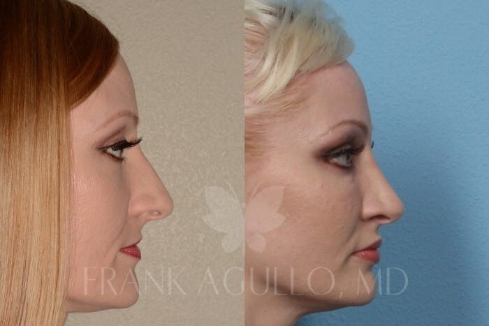 Rhinoplasty Before and After 2