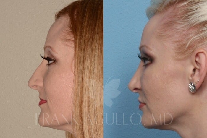 Rhinoplasty Before and After 3