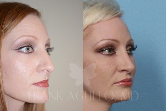 Rhinoplasty Before and After 4