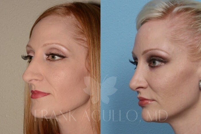 Rhinoplasty Before and After 5