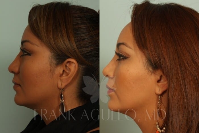 Rhinoplasty Before and After 4