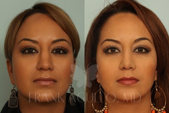 Rhinoplasty Before and After 2