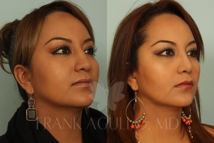 Rhinoplasty Before and After 3