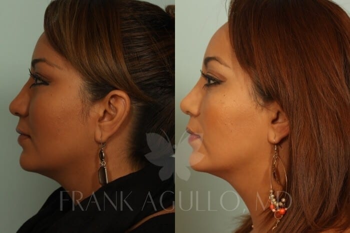 Rhinoplasty Before and After 4