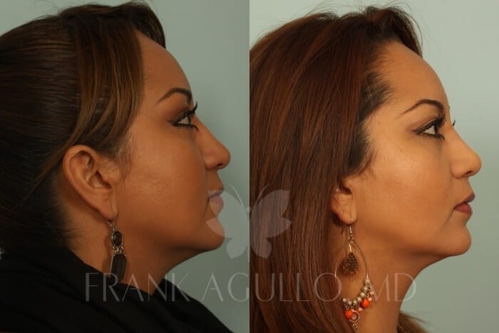 Rhinoplasty Before and After 5