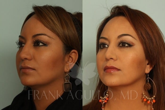 Rhinoplasty Before and After 6