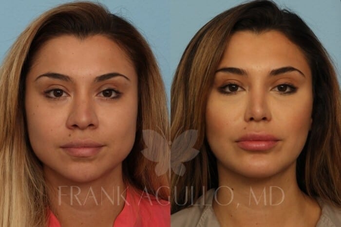 Face Before and After 19